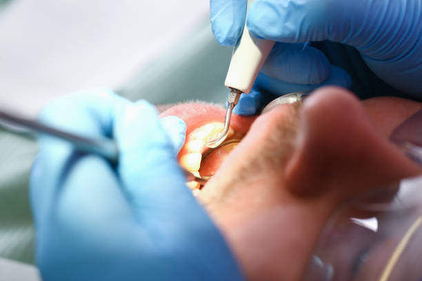 Best Urgent Care for Lost Fillings or Crowns in Sanford, FL