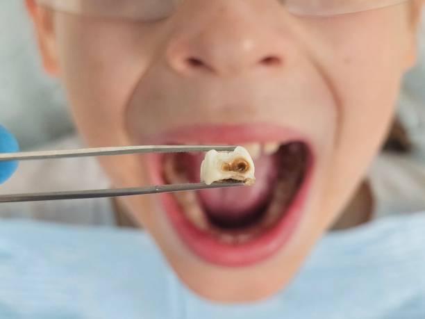 Best Emergency Tooth Extraction in Sanford, FL